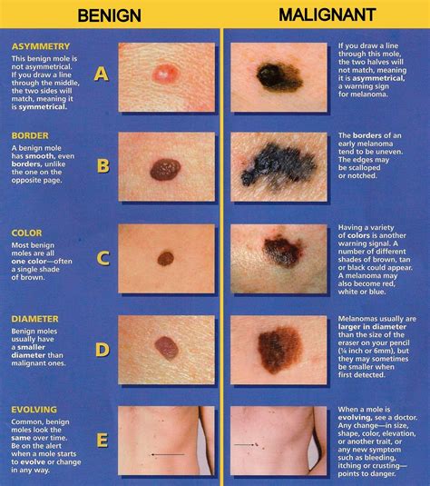 how dangerous is malignant melanoma